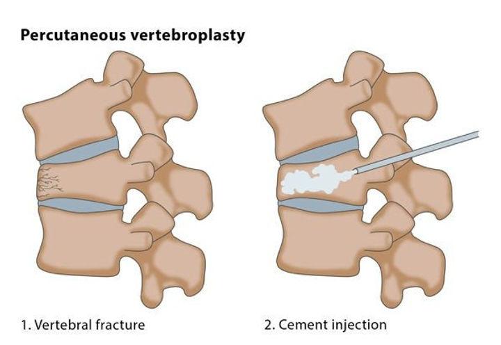 Vertebroplasty and Kyphoplasty